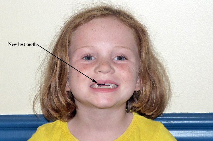 New Lost Tooth
